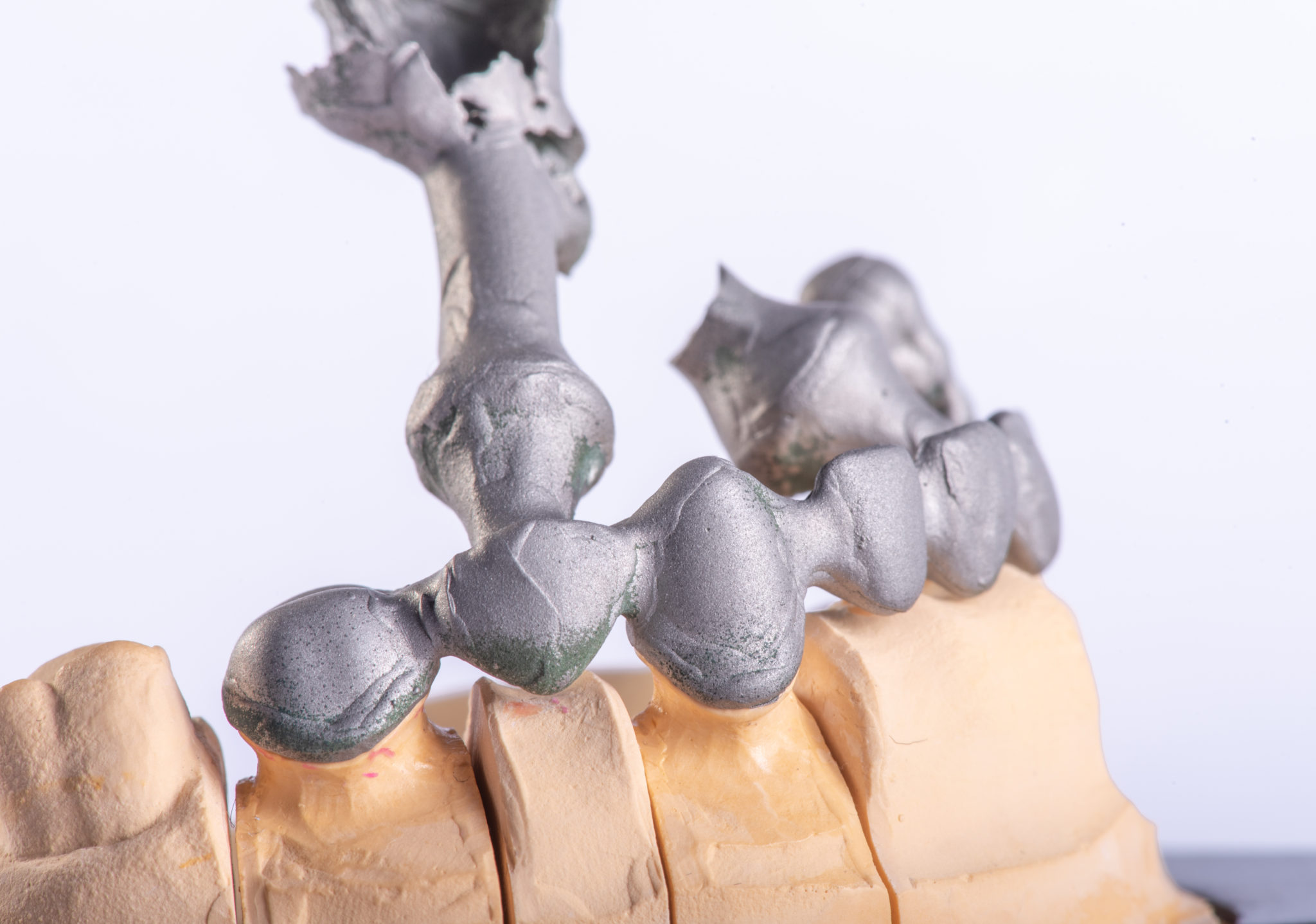 Изготовление металлокерамического протеза. Литье каркаса мостовидного протеза. Коронка цельнолитая (сплав remanium). Литниковая система цельнолитого мостовидного протеза. Литниковая система в ортопедической стоматологии.
