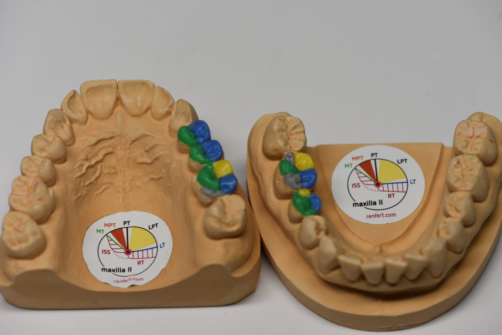 Компас зуба. Моделировка зубов компас. Окклюзионный компас жевательных зубов. Восковое моделирование зубов Wax up Славичек. Моделировка зубов верхней челюсти.